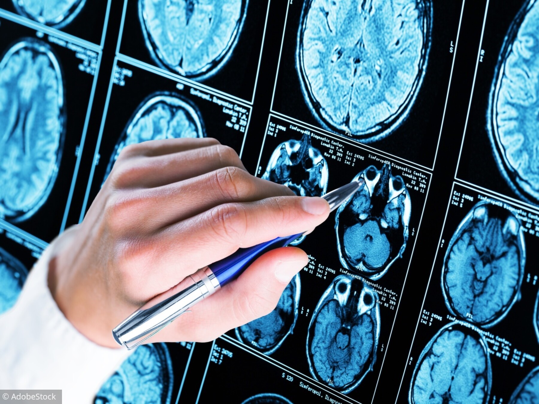 Alzheimer: "L'avenir est au dépistage très précoce"